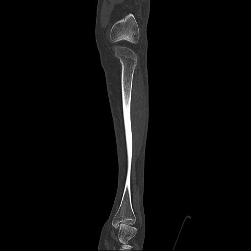 Normal CT tibia and fibula (Radiopaedia 51195-56848 Coronal non-contrast 26).jpg