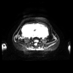 Normal MRI abdomen in pregnancy (Radiopaedia 88001-104541 Axial DWI 17).jpg