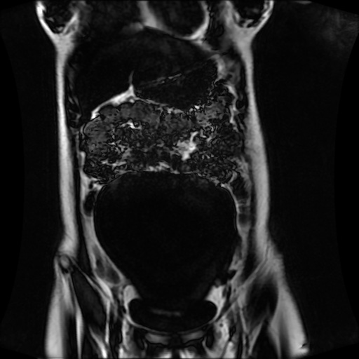 Normal MRI abdomen in pregnancy (Radiopaedia 88001-104541 N 45).jpg