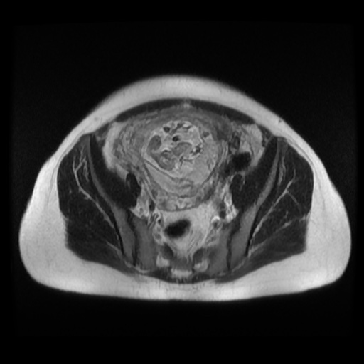 Normal MRI abdomen in pregnancy (Radiopaedia 88003-104546 Axial T2 36).jpg
