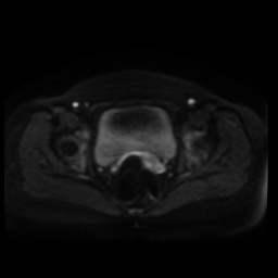 Normal MRI abdomen in pregnancy (Radiopaedia 88005-104548 Axial DWI 50).jpg