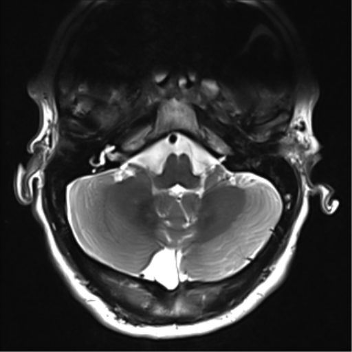 File:Normal MRI cervical spine (infection protocol) (Radiopaedia 53916-60039 Axial T2 1).png