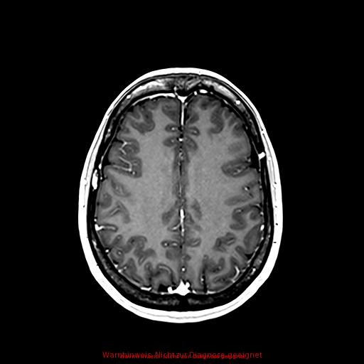 Normal adult brain MRI (non-enhanced and contrast-enhanced) (Radiopaedia 75262-86379 Axial T1 C+ 131).jpg