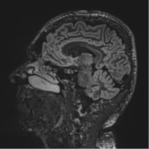 Normal brain MRI (non-focal epilepsy protocol) (Radiopaedia 53917-60040 Sagittal DIR 30).png