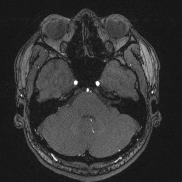 Normal brain MRI including MRA (Radiopaedia 48748-53763 Axial MRA 48).jpg