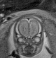 File:Normal brain fetal MRI - 22 weeks (Radiopaedia 50623-56050 Coronal T2 Haste 19).jpg