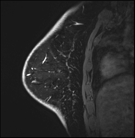 Normal breast MRI - dense breasts (Radiopaedia 80454-93850 I 142).jpg