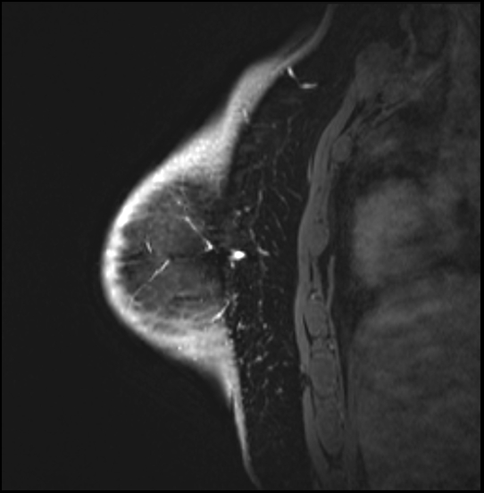 Normal breast MRI - dense breasts (Radiopaedia 80454-93850 I 148).jpg