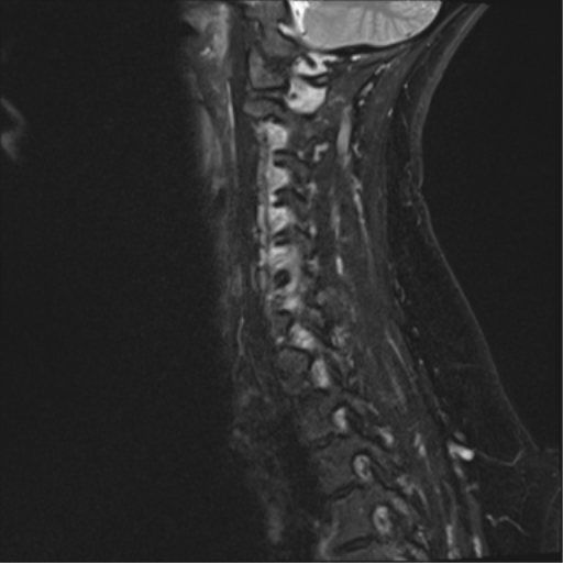 File:Normal cervical spine MRI (including Dixon) (Radiopaedia 42762-45925 Dixon- Water 12).png