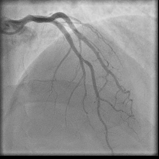 Normal coronary angiogram (DSA) (Radiopaedia 63081-71571 E 45).jpg