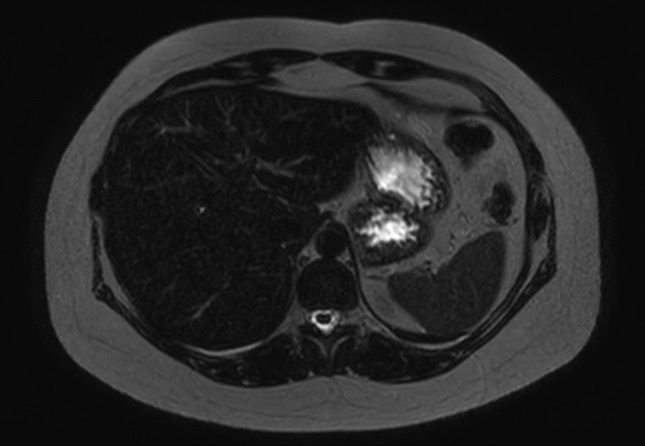 File:Normal liver MRI with Gadolinium (Radiopaedia 58913-66163 E 24).jpg
