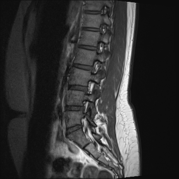 File:Normal lumbar spine MRI- 3 T (Radiopaedia 53280-59250 Sagittal T1 9).jpg