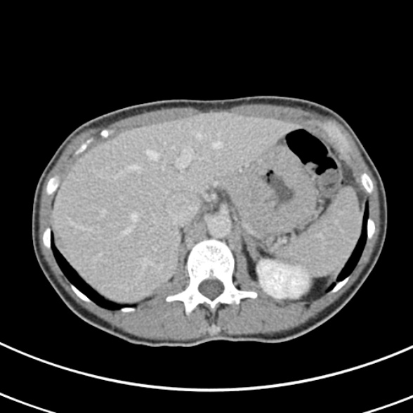 File:Normal multiphase CT liver (Radiopaedia 38026-39996 C 17).jpg