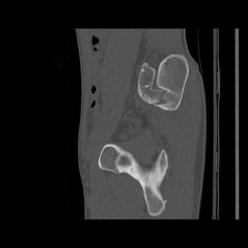 Normal pelvis (Radiopaedia 51473-57238 Sagittal bone window 101).jpg