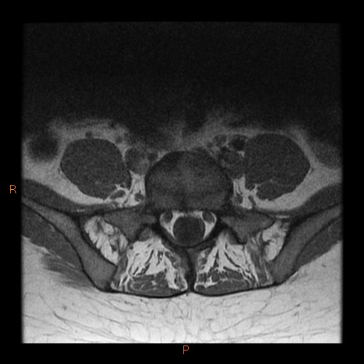 File:Normal spine MRI (Radiopaedia 77323-89408 Axial T1 24).jpg