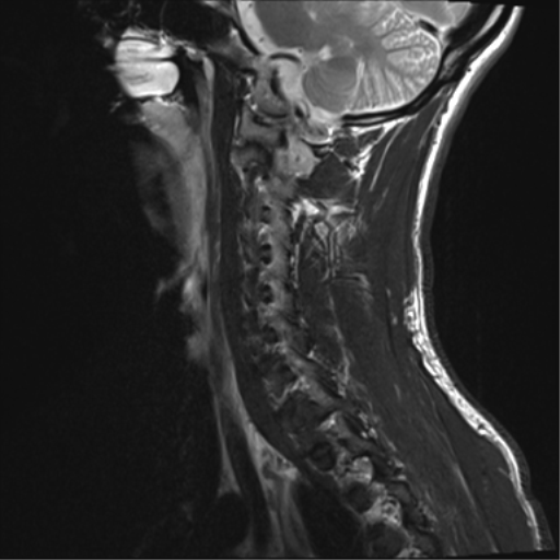File:Normal trauma cervical spine (Radiopaedia 41017-43762 Sagittal T2 4).png