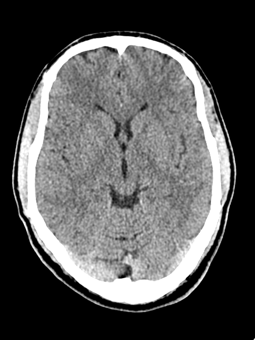 Normal trauma protocol brain and C-spine CT (Radiopaedia 83302-97709 Axial non-contrast 42).jpg