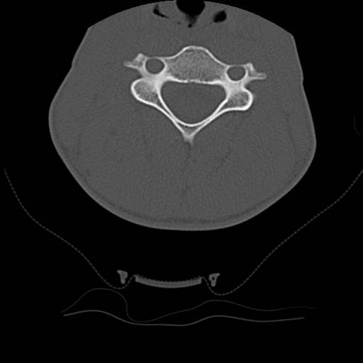 File:Normal trauma spine imaging (age 16) (Radiopaedia 45335-49358 Axial bone window 38).jpg