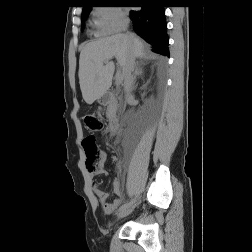 File:Obstructed kidney with perinephric urinoma (Radiopaedia 26889-27066 B 20).jpg