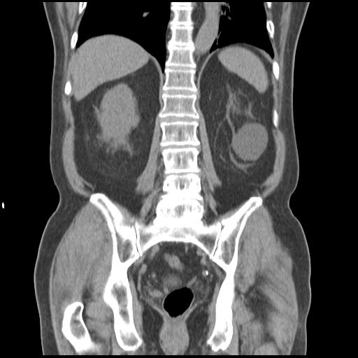 Obstructing renal calculus (Radiopaedia 29517-30016 Coronal non-contrast 38).jpg