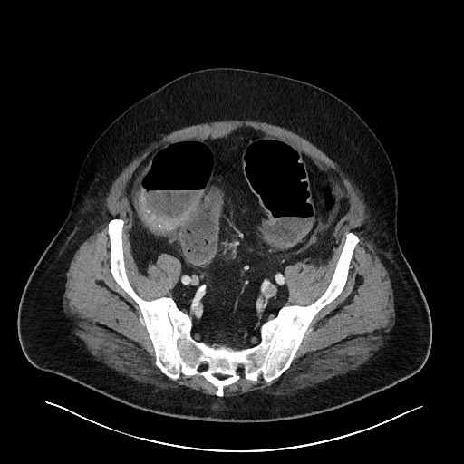 Obstructing sigmoid adenocarcinoma (Radiopaedia 58465-65619 A 128).jpg