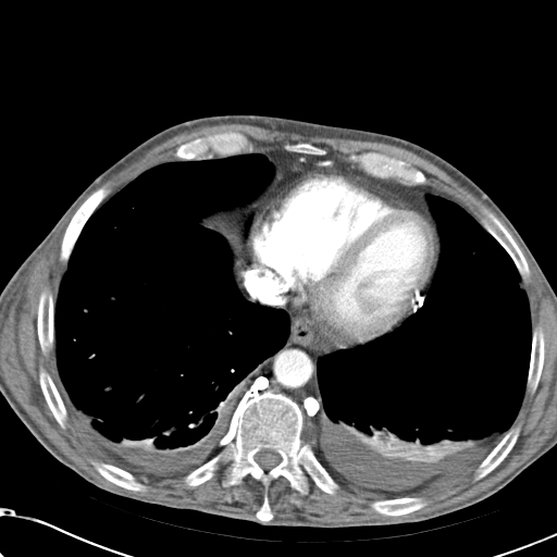 File:Obstructive superior vena cava tumor thrombus (Radiopaedia 28046-28306 A 42).jpg