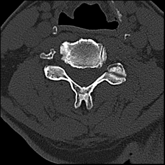 Occipital condyle fracture (type 1) (Radiopaedia 87670-104084 Axial bone window 51).jpg