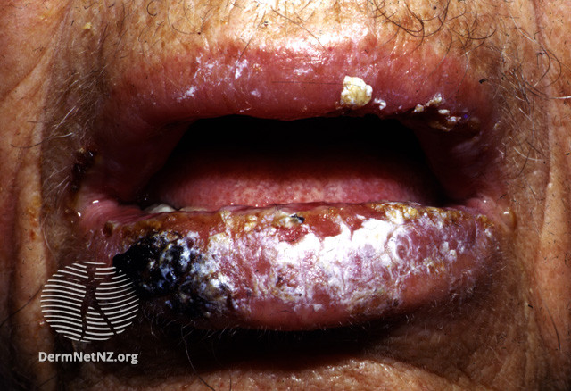 File:Oral pemphigus vulgaris (DermNet NZ immune-pgus2).jpg