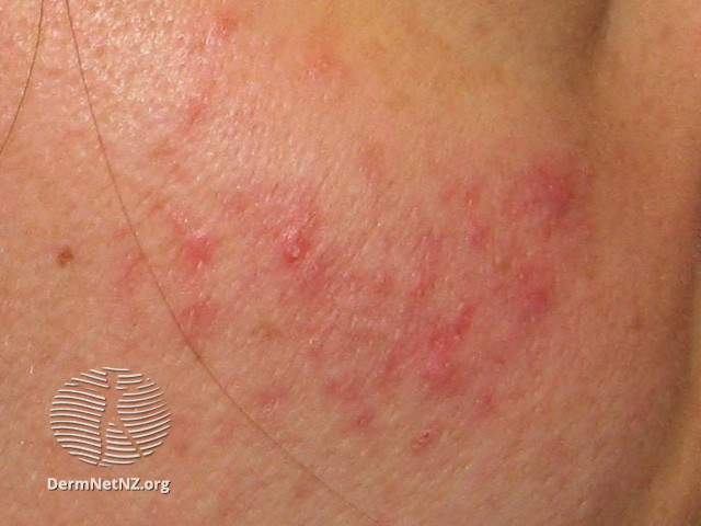 Rosacea (DermNet NZ acne-red-face-3638).jpg