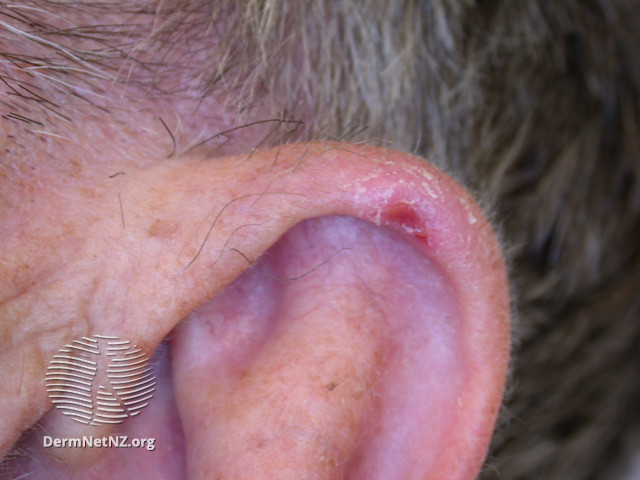 File:Ulcerated chondrodermatitis nodularis helicis (DermNet NZ site-age-specific-ear-cnh-ulcerated).jpg