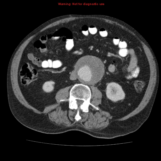 Abdominal aortic aneurysm (Radiopaedia 10122-10660 Axial C+ portal venous phase 41).jpg