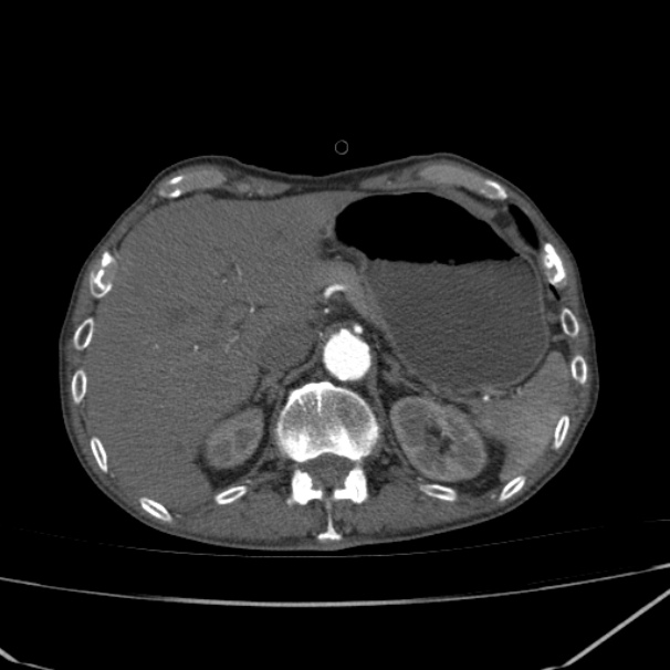 Abdominal aortic aneurysm (Radiopaedia 23703-23856 Axial C+ arterial phase 13).jpg