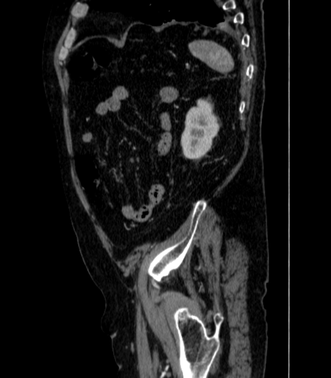 Abdominal aortic aneurysm (Radiopaedia 25855-26001 Sagittal C+ arterial phase 72).jpg