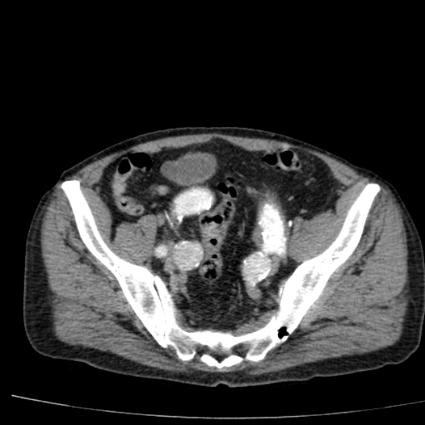 Abdominal aortic aneurysm (Radiopaedia 29248-29660 Axial C+ arterial phase 71).jpg