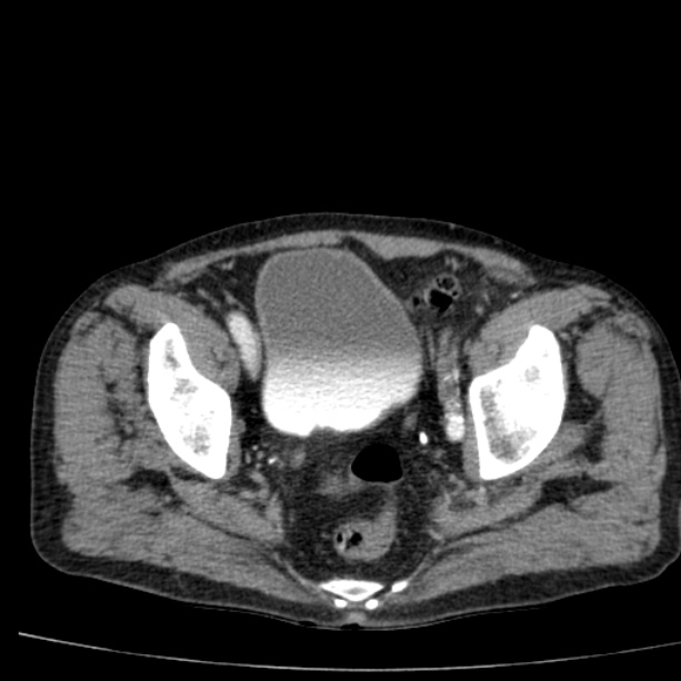 Abdominal aortic aneurysm (Radiopaedia 29248-29660 Axial C+ arterial phase 79).jpg