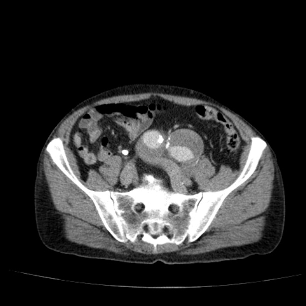 Abdominal aortic aneurysm (Radiopaedia 29248-29660 Axial C+ portal venous phase 46).jpg