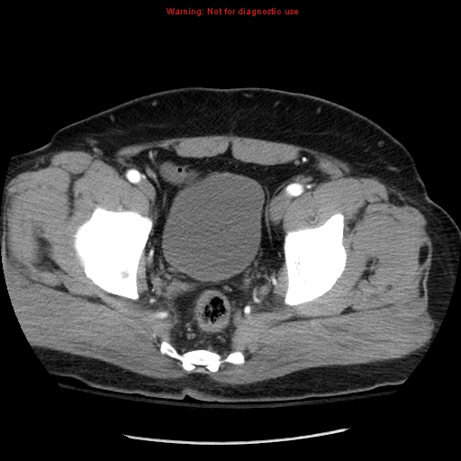 Abdominal aortic aneurysm (Radiopaedia 8190-9038 Axial C+ arterial phase 75).jpg