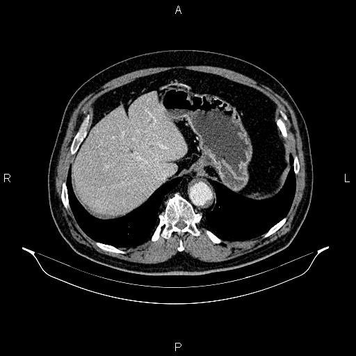 Abdominal aortic aneurysm (Radiopaedia 83094-97462 Axial renal cortical phase 69).jpg