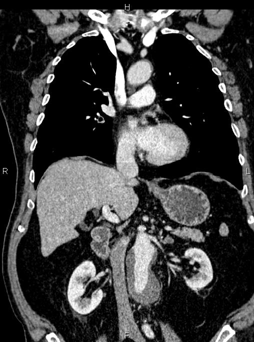 Abdominal aortic aneurysm (Radiopaedia 83094-97462 Coronal renal cortical phase 47).jpg