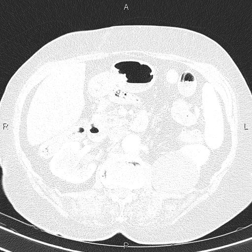 File:Abdominal aortic aneurysm (Radiopaedia 85063-100606 Axial lung window 72).jpg