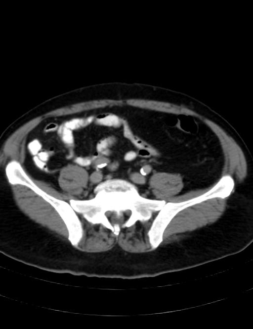 Abdominal lymphoma - with sandwich sign (Radiopaedia 53486-59492 Axial C+ portal venous phase 36).jpg
