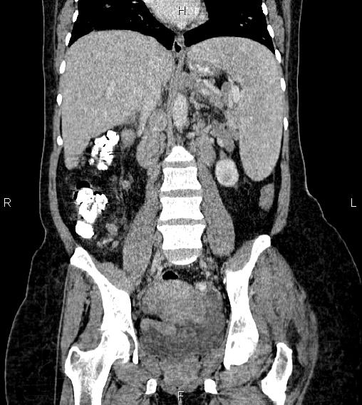 File:Abdominal lymphoma with sandwich sign (Radiopaedia 84378-99704 Coronal C+ portal venous phase 37).jpg