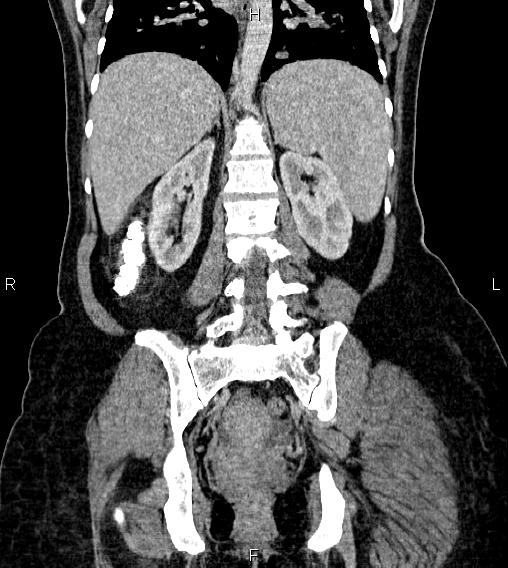 Abdominal lymphoma with sandwich sign (Radiopaedia 84378-99704 Coronal C+ portal venous phase 46).jpg
