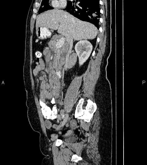 Abdominal lymphoma with sandwich sign (Radiopaedia 84378-99704 Sagittal C+ portal venous phase 32).jpg