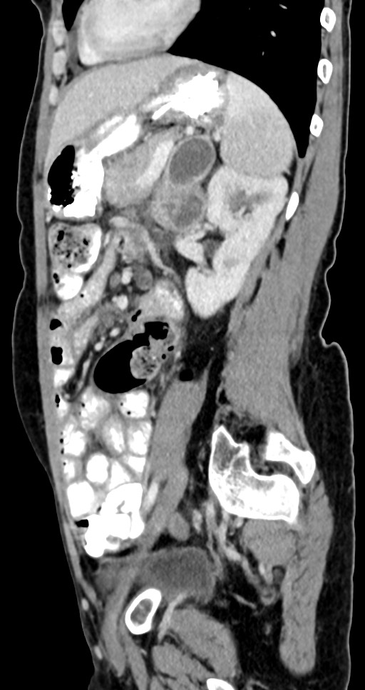 Abdominal wall and retroperitoneal tuberculosis (Radiopaedia 88137-104729 Sagittal C+ portal venous phase 54).jpg