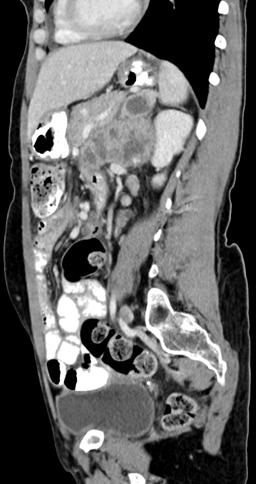 Abdominal wall and retroperitoneal tuberculosis (Radiopaedia 88137-104729 Sagittal C+ portal venous phase 60).jpg