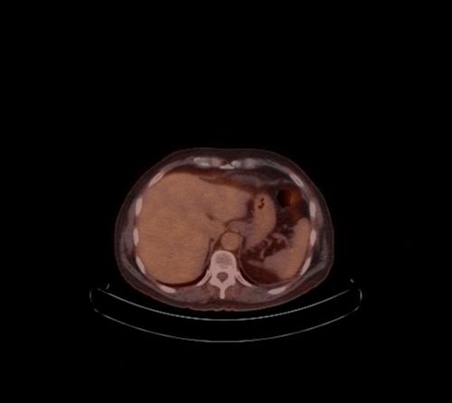 Abdominal wall metastasis from colorectal carcinoma (Radiopaedia 31016-31719 C 89).jpg