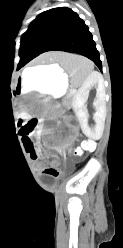 Abdominopelvic rhabdomyosarcoma (Radiopaedia 78356-90984 Sagittal C+ portal venous phase 26).jpg
