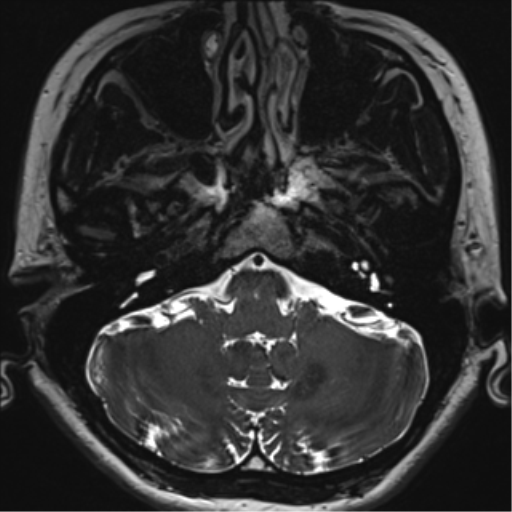 File:Abducens nerve palsy (Radiopaedia 51069-56648 Axial T2 fat sat 12).png