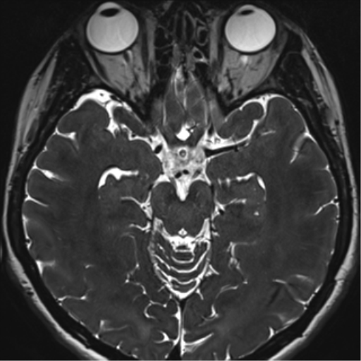 File:Abducens nerve palsy (Radiopaedia 51069-56648 Axial T2 fat sat 63).png